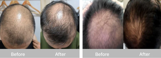 Hair regeneration before/after