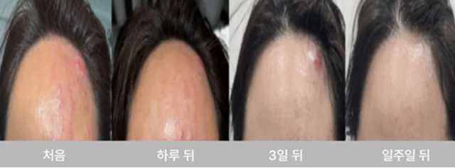 Shingles and burn scar treatment progress