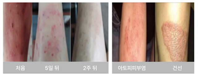 Skin regeneration before/after