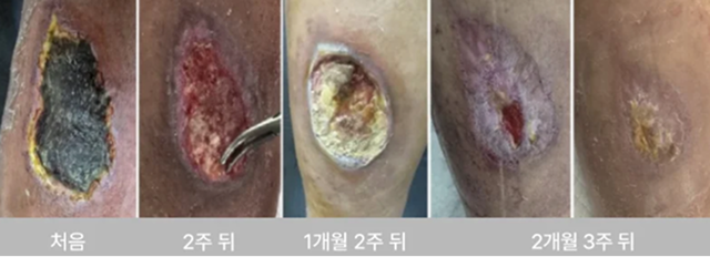Diabetic foot ulcer treatment progress